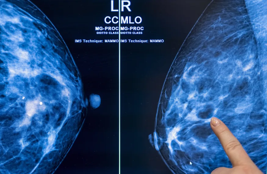 El cribado del cáncer con inteligencia artificial podría reducir a la mitad la carga de trabajo de los radiólogos, según un estudio El cribado del cáncer con inteligencia artificial podría reducir a la mitad la carga de trabajo de los radiólogos, según un estudio
